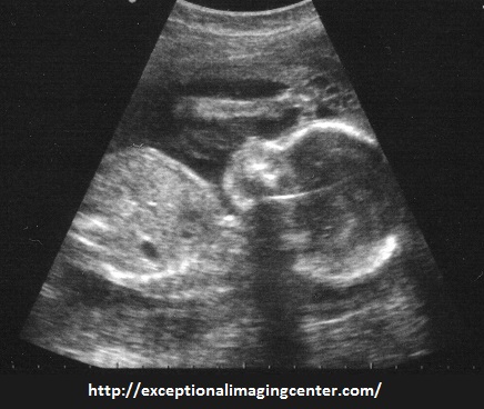 Sonogram image of a developing human fetus