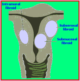 3 types of uterine tumors