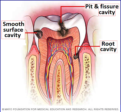 3 types of tooth cavity