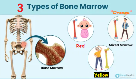 3 types of Bone Marrow used as an analogy